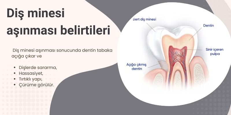 Diş minesi aşınması belirtileri Diş minesi aşınması belirtileri - Antalya
