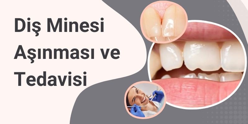Diş Minesi Aşınması ve Tedavisi Antalya