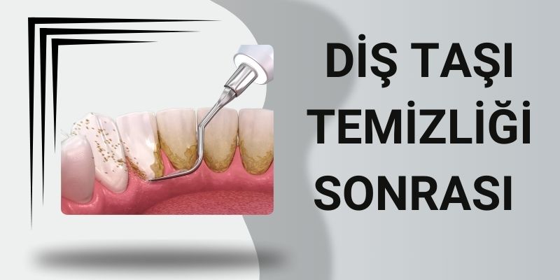 Diş Taşı Temizliği Sonrası Antalya