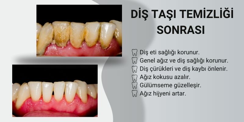 Diş taşı temizliğinin faydaları nelerdir? Diş taşı temizliğinin faydaları nelerdir? - Antalya
