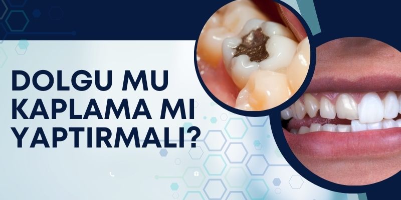 Dolgu mu Kaplama mı Yaptırmalı? Antalya