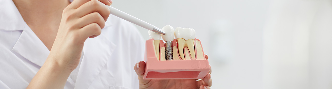 Diş implantı nasıl yapılır? 