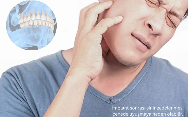 İmplant sonrası sinir hasarı belirtileri İmplant sonrası sinir hasarı belirtileri