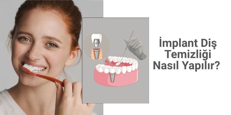  İmplant Diş Temizliği Nasıl Yapılır? Antalya