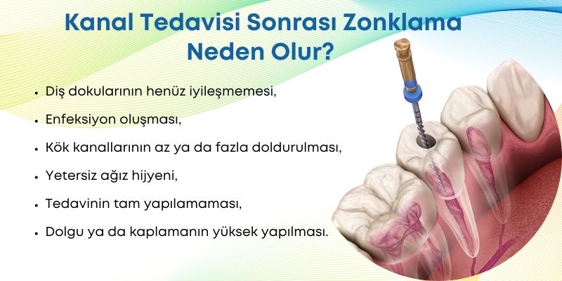 Kanal tedavisi sonrası zonklama neden olur? Kanal tedavisi sonrası zonklama neden olur? Antalya