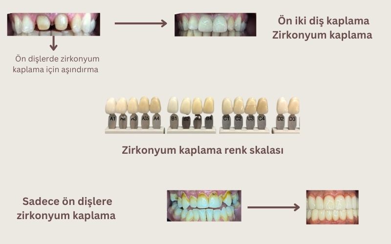 Sadece ön dişlere zirkonyum kaplama Antalya Sadece ön dişlere zirkonyum kaplama Antalya