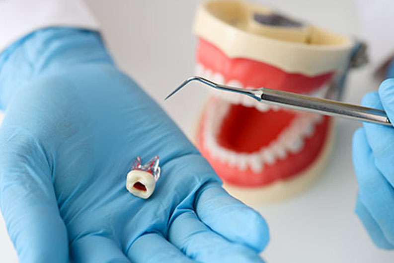 Endodonti (Kanal Tedavisi) Antalya 